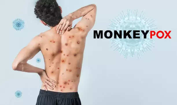 The High Level Committee of the State Medical Expert Panel suggested the dangerous 30 days to come regarding monkeypox