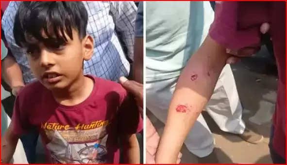 गाजियाबाद में छात्र पर पिटबुल का अटैक:सड़क पर गिराकर हाथ-पैर और कमर पर नोंचा, डॉग मालिक पर एफआईआर  
