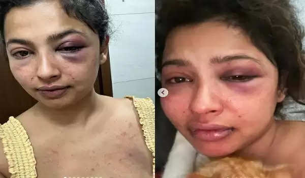 मलयालम एक्ट्रेस Anicka Vikramman को एक्स बॉयफ्रेंड ने पीटा, तस्वीर शेयर कर दिखाए चोट के निशान